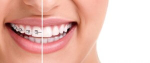 dental insurance for braces for adults