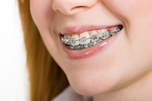 dental insurance for braces for kids