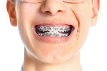 Does Dental Insurance Cover Braces for Adults?  