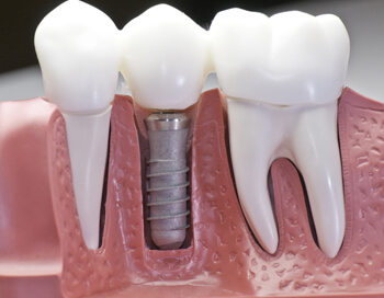 dentists performing dental implants covered by emblemhealth