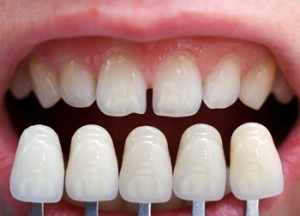 dental insurance that covers veneers