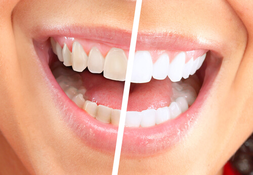 Discount Dental Plans Work with Cosmetic Dentistry