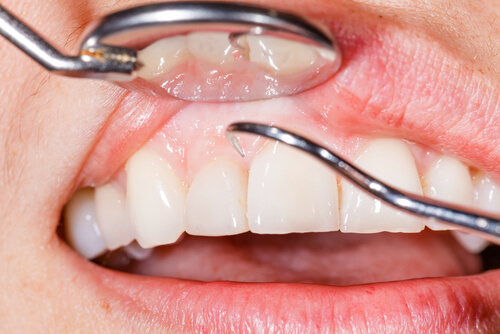 How Can Gum Grafting Save My Teeth?